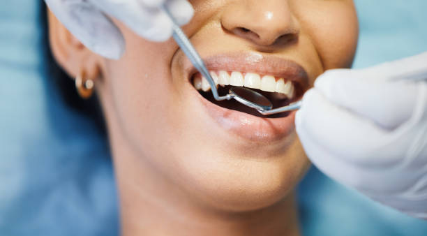 Best Emergency Wisdom Teeth Removal in Culver, IN